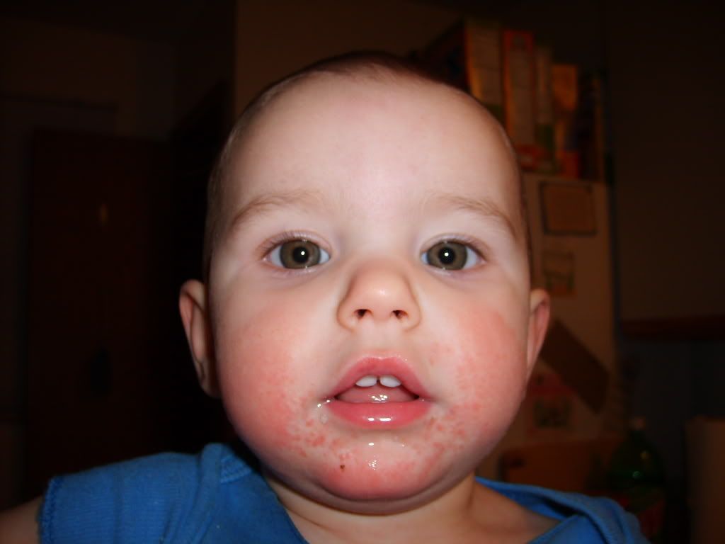 sudden-milk-allergy-in-a-one-year-old-how-to-know-what-it-is-yahoo